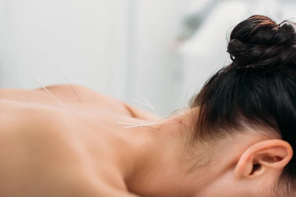 Partial view of woman with needles on body having acupuncture therapy in spa salon — Stock Photo