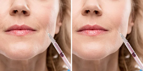 Collage of middle aged woman receiving beauty injection before and after retouching — Stock Photo