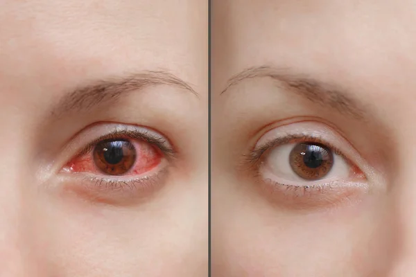 Close up one annoyed red blood human girl eye, health eye affected by conjunctivitis or after flu cold allergy. Looking camera. Disease treatment medicine health concept. Copy space. Workspace mockup