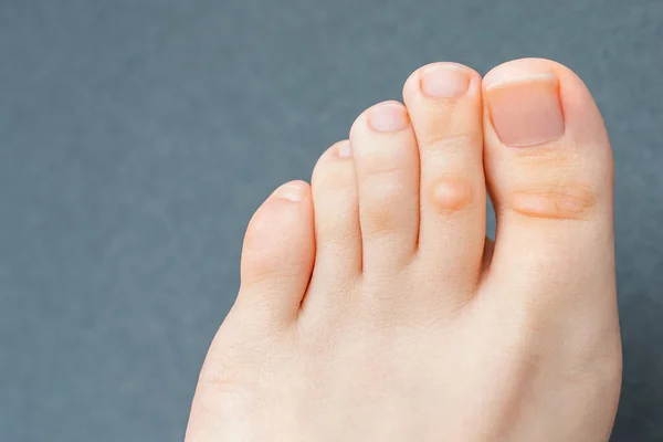 A young woman has hard corns and calluses on her toes from wearing shoes that uncomfortable and don\'t fit properly. Female foot. Close up view.