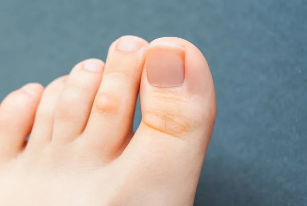 Young Woman Has Hard Corns Her Toes Wearing Shoes Don — Stock Photo, Image