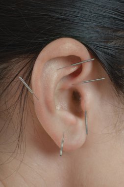 Auricle üzerinde akupunktur terapisi