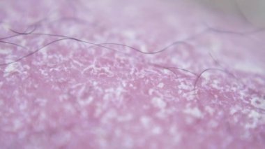 Makro çekim. Sedef hastası bir adamın bacağına yakından bakın. Cilt Hastalıkları. Bulaşıcı olmayan bir hastalık. 2