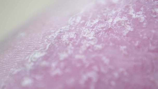 Macro shot. Regardez de près le pied d'un homme souffrant de psoriasis. Maladie de peau . 