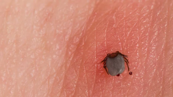 Szopás szarvas kullancs. Szekréció cseppek az emberi bőrön. Kínai ricinus — Stock Fotó