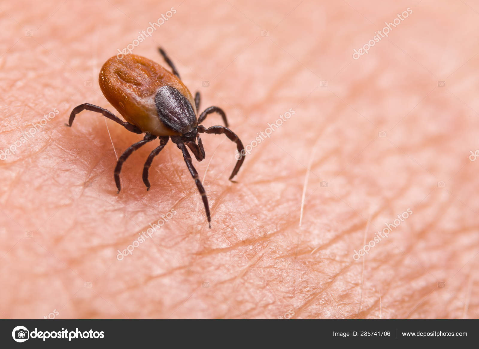 受感染的雌鹿在毛茸茸的人类皮肤上滴答作响。伊克索德·里米努斯寄生虫。阿卡鲁斯——图库图片© KPixMining #285741706, image size:1600x1167