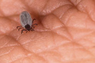 Hint fasulyesi kenesi ısırarak deriyi delip geçmiş ve avuçlarını açmış. Ixodes ricinus. İnsan derisini delen küçük bir parazit akarı. Şişman parazit vücudu. Kene kaynaklı hastalıklar.