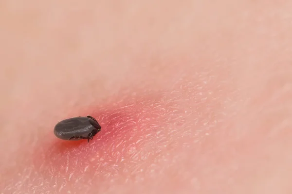 Female castor bean tick sucking blood in red irritated skin. Ixodes ricinus. Fattened parasite full of blood bitten in human epidermis. Bloated parasitic mite. Tick-borne diseases as Lyme borreliosis.