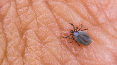 İnsan derisi dokusunda küçük dişi geyik kenesi. Ixodes ricinus veya skapularis. Parazit mayt yakın plan. Vücudu kanla dolu ve üst deride görünen hipostom var. Ensefalit veya Lyme hastalığı.