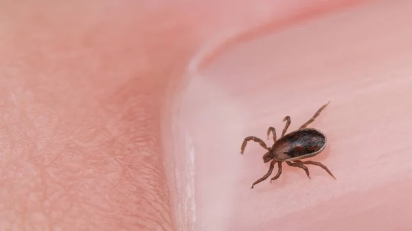 Male Deer Tick Nail Human Finger Detail Ixodes Ricinus Closeup — Stock Photo, Image