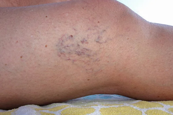 成熟した女性の静脈瘤足のクローズ アップ — ストック写真