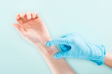 mavi hastanın elinde alerjik reaksiyon inceleyen doktor kırpılmış görünümü 