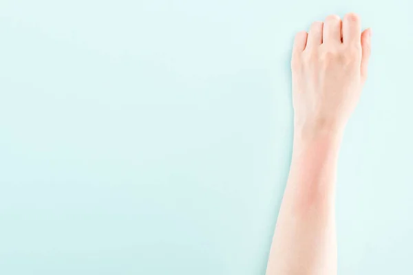 Vista Cortada Mão Com Reação Alérgica Isolada Azul — Fotografia de Stock