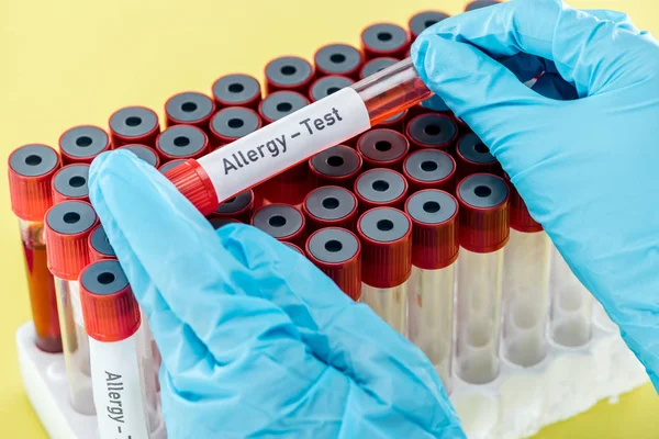 Beskåret Visning Læge Latexhandsker Der Holder Prøve Med Allergi Testinskription - Stock-foto