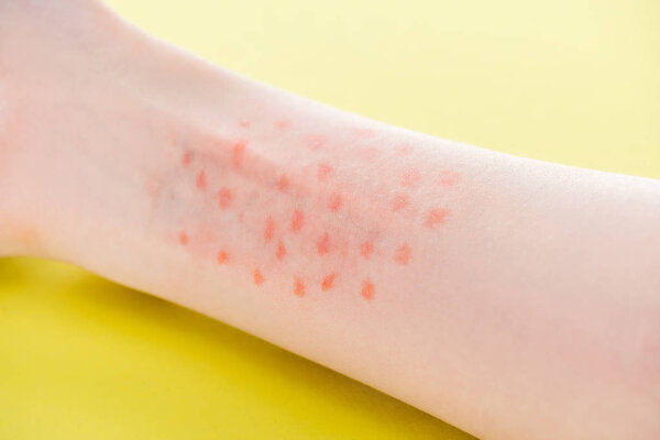 обрезанный вид аллергии на руку на желтом фоне
