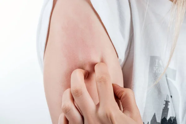 Cropped View Woman Itching Hand Isolated White — Stock Photo, Image