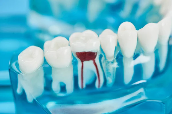 Selektiv Fokusering Tänder Modell Med Vita Tänder Och Röd Dental — Stockfoto