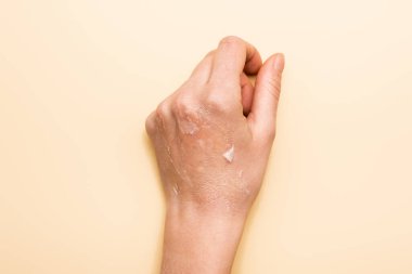 cropped view of female hand with dehydrated, exfoliated skin on beige clipart