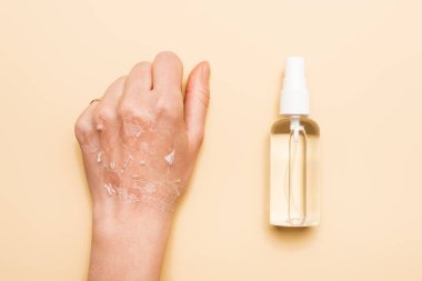 cropped view of female hand with dehydrated, exfoliated skin near disinfectant on beige clipart