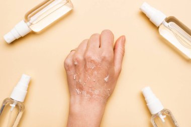 cropped view of female hand with dry, exfoliated skin near spray bottles with antiseptic on beige clipart