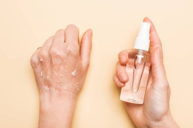 partial view of woman holding antiseptic spray near hand with dead, exfoliated skin on beige clipart