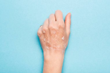cropped view of female hand with dry, exfoliated skin on blue clipart