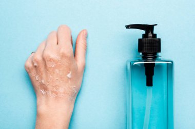 partial view of female hand with exfoliated, dry skin near sanitizer on blue clipart