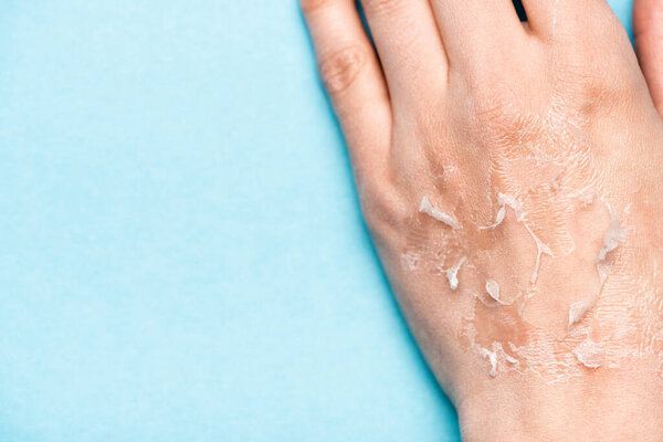 частичный вид женской руки с обезвоженной, отшелушенной кожей на синем
