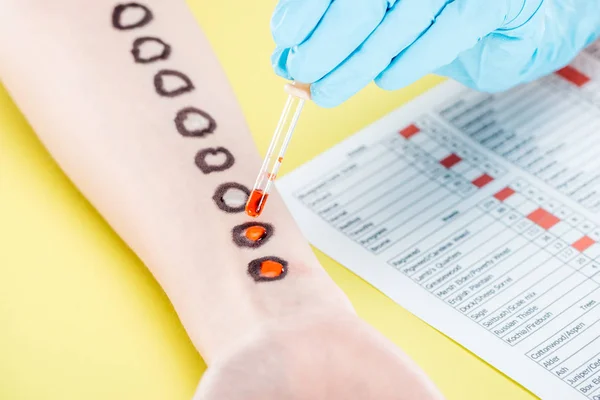 Vista recortada del médico que examina la reacción alérgica cerca de los resultados de la prueba de alergia en amarillo - foto de stock