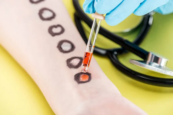 Vue recadrée du médecin examinant la réaction allergique avec pipette près du stéthoscope sur jaune — Photo de stock