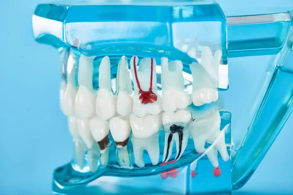 Enfoque selectivo del modelo de dientes con raíces dentales rojas en dientes blancos aislados en azul - foto de stock