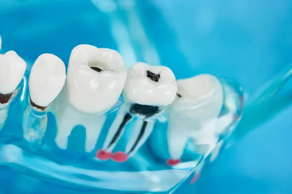 Selective focus of teeth model with dental caries in white teeth on blue — Stock Photo