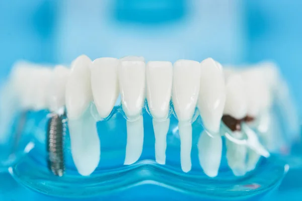 Primer plano del modelo de dientes con raíces dentales en dientes blancos sobre azul - foto de stock