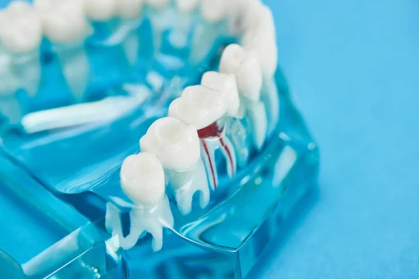 Enfoque selectivo del modelo de dientes con raíz dental roja aislada en azul - foto de stock