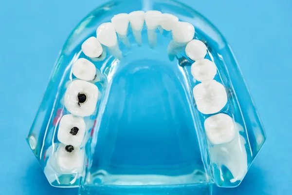 Селективный фокус модели зубов с кариесом на синем — стоковое фото