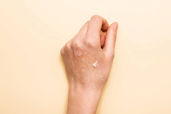 Cropped view of female hand with dehydrated, exfoliated skin on beige — Stock Photo