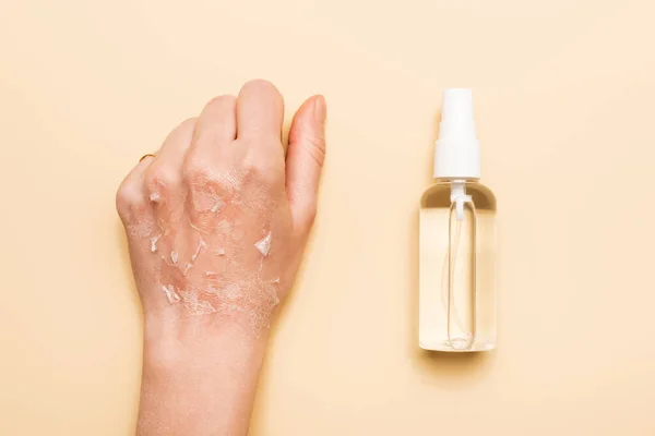 Cropped view of female hand with dehydrated, exfoliated skin near disinfectant on beige — Stock Photo