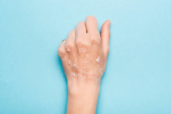 Обрізаний вид жіночої руки з сухою, відлущеною шкірою на синьому — стокове фото