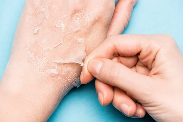 Cropped view of woman peeling off exfoliated, dry skin from hand on blue — Stock Photo