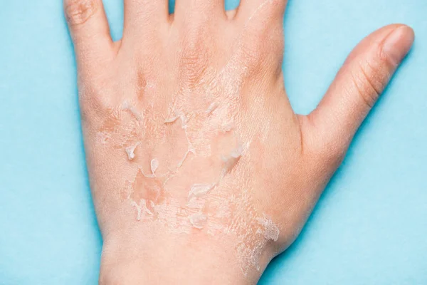 Partial view of female hand with dry, exfoliated skin on blue — Stock Photo