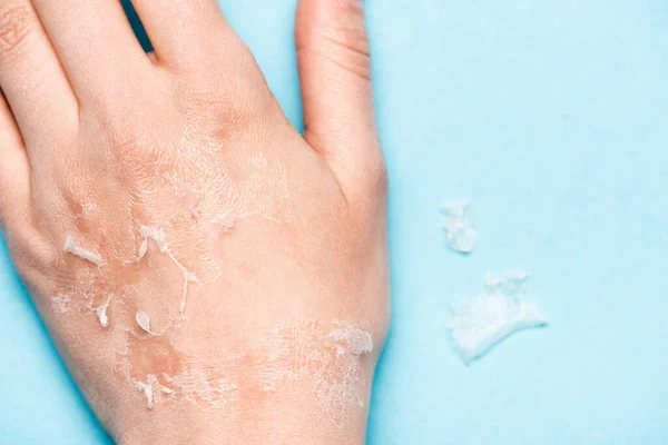 Cropped view of female hand with dead, exfoliated skin on blue — Stock Photo