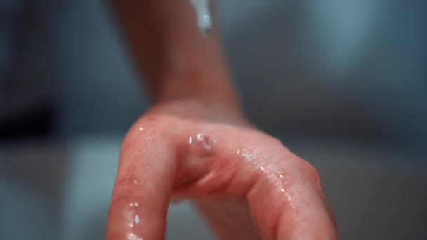 Девочка наливает пероксид на открытую рану — стоковое видео