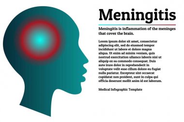 Tıbbi bilgi grafiği şablonu. Menenjit - beyin menenjit iltihabı. İltihap lokalizasyon işareti ile insan kafası silueti. Metniniz için yer kopyalayın. Poster, sunum, broşür için.