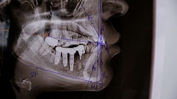 O dentista mostra um plano de tratamento para a radiografia lateral dos dentes. Consulta antes de instalar o sistema de suporte — Vídeo de Stock