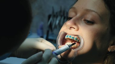 Diş hekimi ortodontik mavi tutkal dişlerde mandal kadında anten sistemi yakın çekim yüklemeden önce uygulanır. Stomatologist ortodontist ziyaret