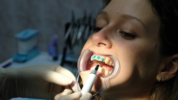 Dentista aplica uma cola azul ortodôntica especial sobre os dentes para a mulher na trava antes de instalar o sistema de suporte close-up. Visita ao estomatologista ortodontista — Fotografia de Stock