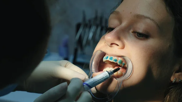 Tandarts geldt orthodontische blauwe lijm op de tanden aan de vrouw in de hendel voor de installatie van de beugel systeem close-up. Bezoek aan de stomatologist-orthodontist — Stockfoto