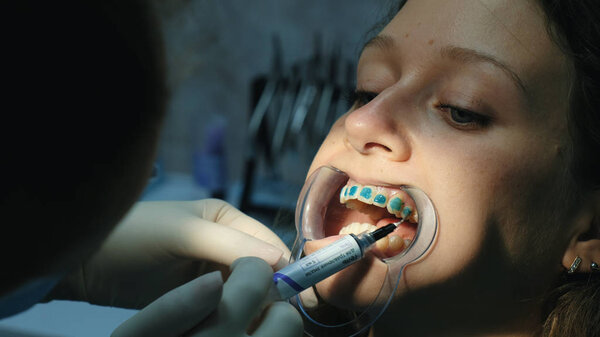 Dentist applies orthodontic blue glue on the teeth to the woman in the latch before installing the bracket system close-up. Visit to the stomatologist orthodontist
