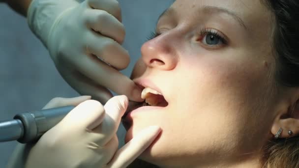 Dentista mói e limpa os dentes antes de instalar o sistema de suporte close-up. Visita ao dentista — Vídeo de Stock