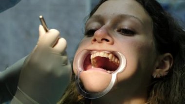 Metal diş telleri yükleme ve sabitleme. Ortodontist dişçi bite düzeltme yakın çekim ziyaret